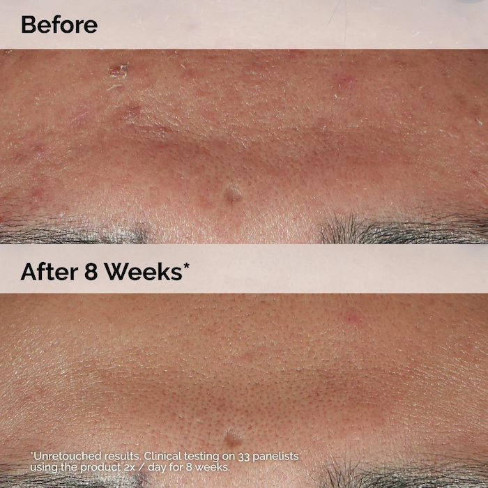 سرم ضد جوش Niacinamide 10% + Zinc 1% اوردینری حجم 30 میلی لیتر