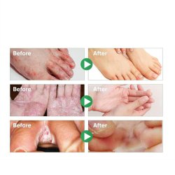 اسپری گیاهی ضدبو و درمان زخم پا حجم 30 میلی لیتر